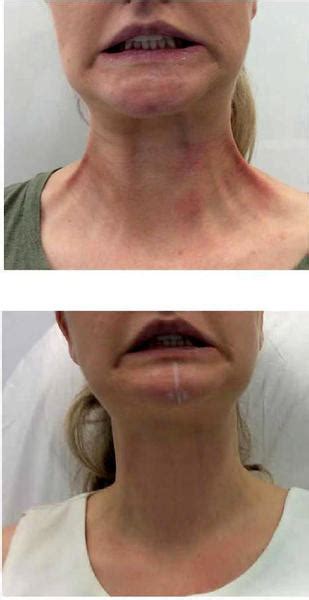 Botox Injections In Neck Muscles