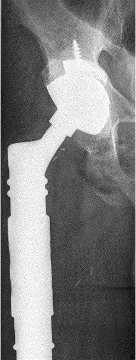 Acetabular Erosion After Bipolar Hemiarthroplasty In Proximal Femoral