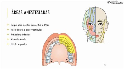 Tecnica Alveolar Superior Posterior TikTok