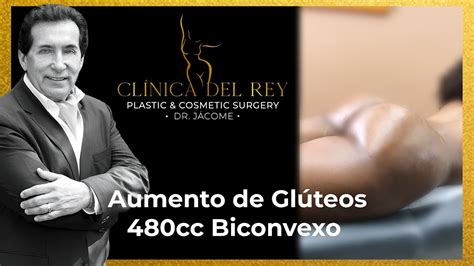 1 Semana Implante de Glúteos 480cc Biconvexo y Lipoescultura Clínica