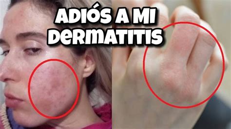 Dermatitis ¿funcionan Las Cremas I Mi Historia De Sanación Youtube