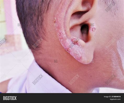 Ear Skin Infection Image & Photo (Free Trial) | Bigstock