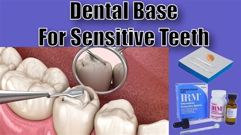 Dental Bases Mixing And Placement Dental Assisting Youtube