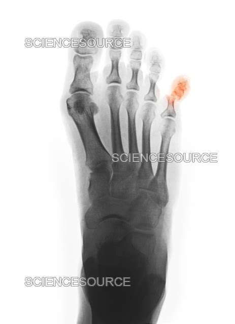 X Ray Showing Fractured Pinky Toe Stock Image Science Source Images