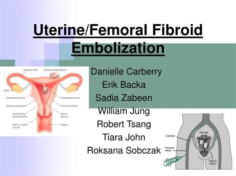 PPT Uterine Femoral Fibroid Embolization PowerPoint Presentation