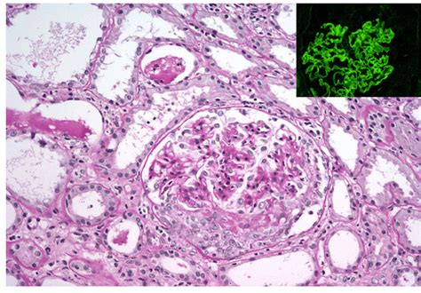 Renal Biopsy Necrotizing And Crescentic Lesions With Marked