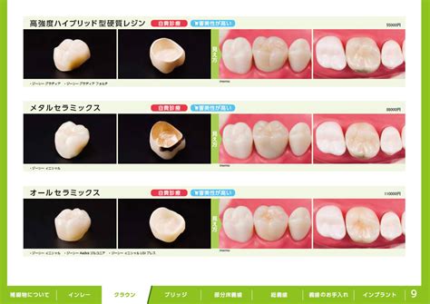 補綴物｜クラウン（被せ物・差し歯）│藤原歯科医院