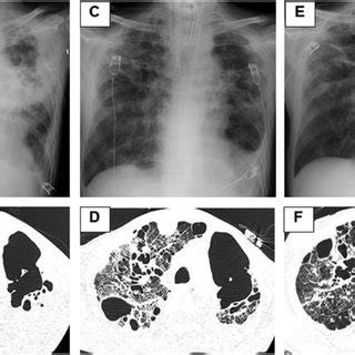 Chest X Ray And Computed Tomography Images A And B On The Day Of