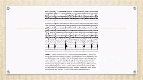 Periodic Limb Movement Disorder Ppt