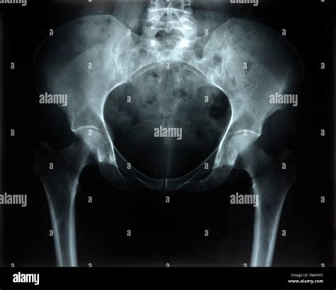 Pelvic Exam Hi Res Stock Photography And Images Alamy