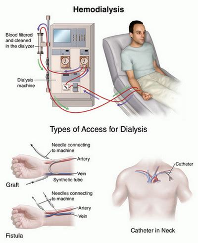 What is Uremia? | Current Health Advice, Health Blog Articles and Tips