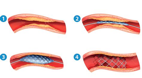 Stent Angioplasty Procedure Plaque Illustration Procedure Vector