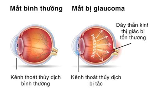 B Nh Glaucoma L G M T S Nguy N Nh N V C Ch I U Tr Hi U Qu