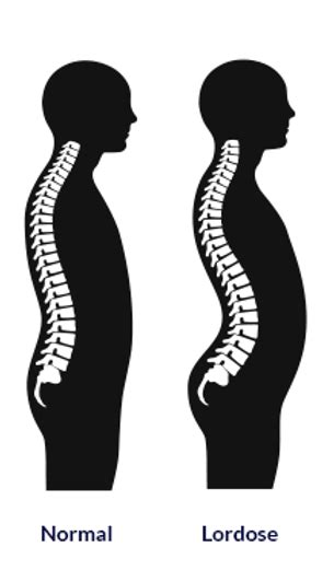 Causas Sintomas E Tratamento Da Lordose