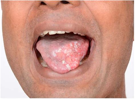 Squamous Cell Carcinoma Of The Tongue In A Patient With Dyskeratosis