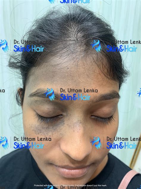 Gallery Advanced Diagnosis And Treatment Dr Uttam Lenkas Skin