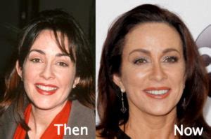 Patricia Heaton Plastic Surgery Before and After Photos