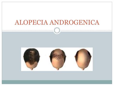 Alopecia Androgenica Ppt