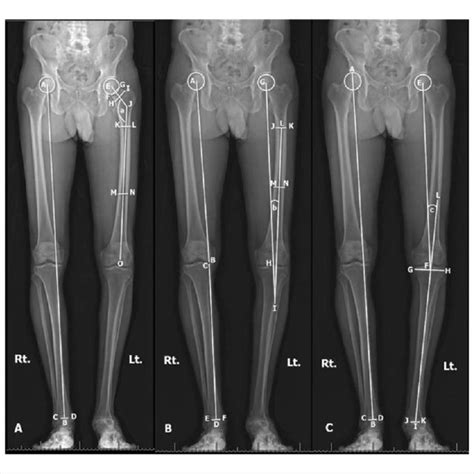 Scanogram Standing