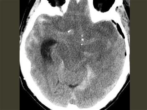 Brain herniation imaging