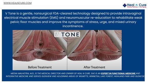 Ppt Non Surgical Methods For Vaginal Rejuvenation Functional