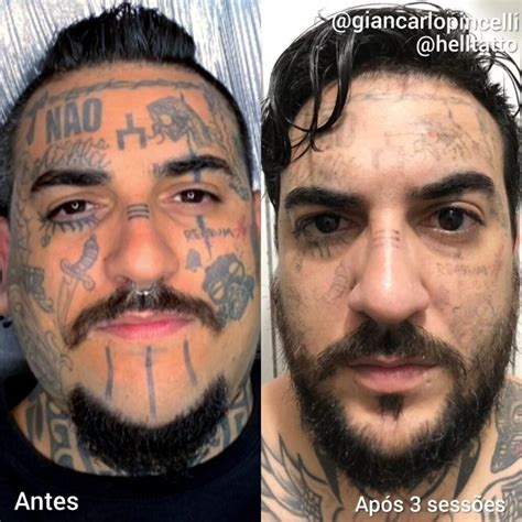 Remo O De Tatuagem No Rosto Hell Tattoo Especialistas Em Remo O A