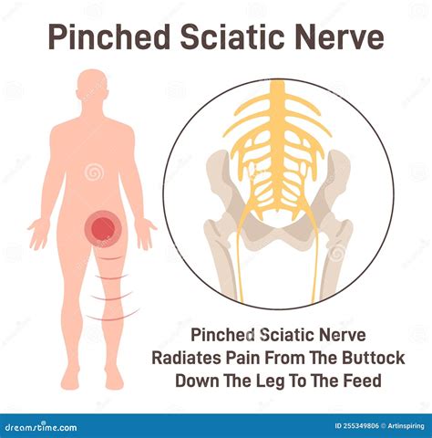 Sciatica Pinched Sciatic Nerve Causing Pain And Inflammation In Pelvis Stock Vector