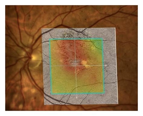 OCT- versus RM-SLO-guided treatment plan for macular laser ...