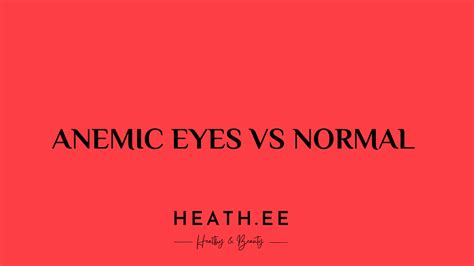 Anemic Eyes vs Normal: What’s the Difference? - Heathe