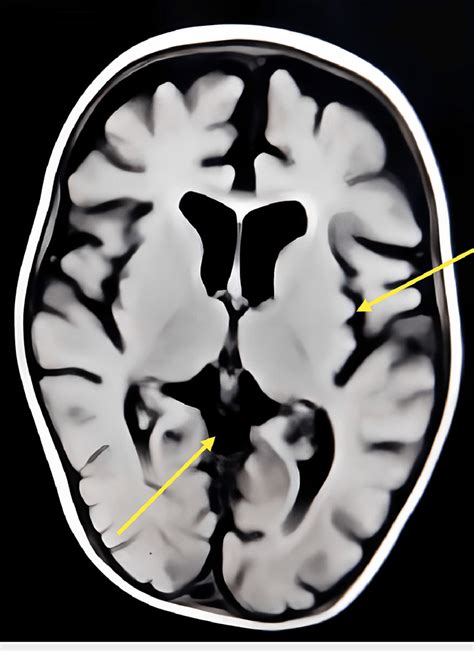 Mri Showing Cerebral Atrophy And Ventricular Prominence Download