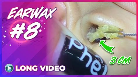 Ep 8 Asmr Earwax Collection Of Ear Wax Removal Sessions Will Make You