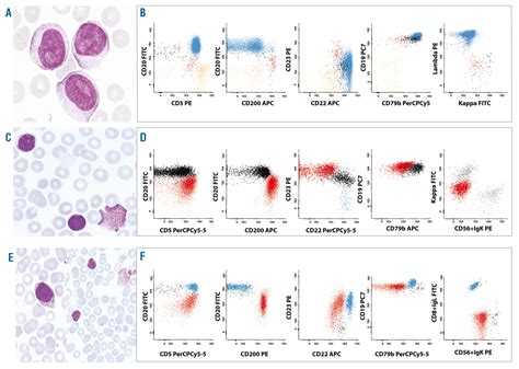 Chronic Lymphocytic Leukemia Cells