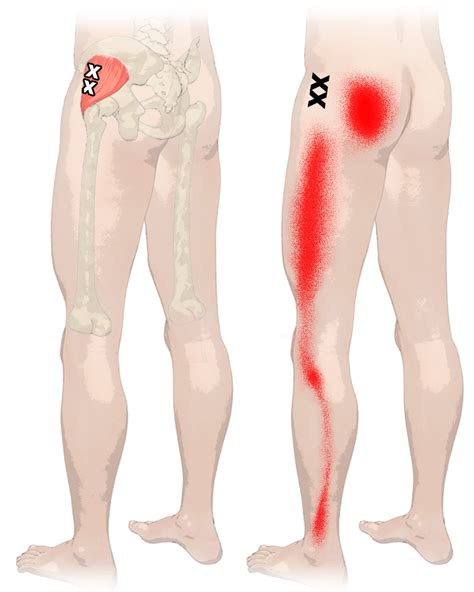 Gluteus Medius Trigger Points