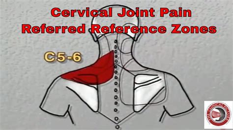 Cervical Pain Patterns