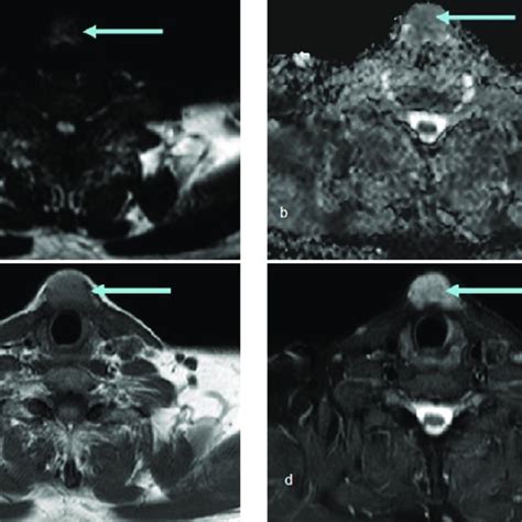 A D Mri Images A Axial Dwi B Axial Adc Map C Axial T1wi D