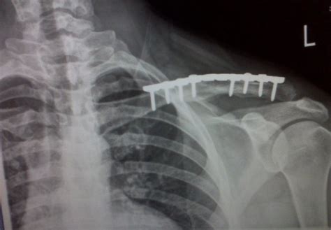 Clavicle Fractures: Non-op or Surgery? - Ortho Conditioning