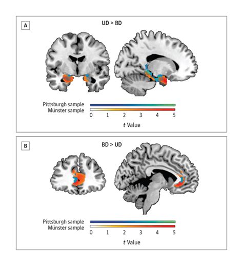 Brain Morphometry Separates Bipolar Vs Unipolar Gateway Psychiatric