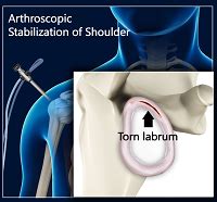 Shoulder Procedures Yuma Az Shoulder Arthroscopy Yuma