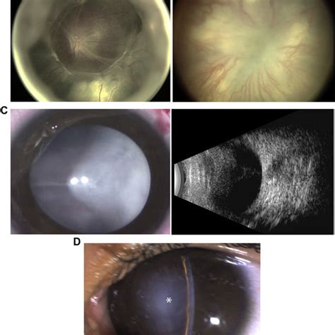 Examples Of Retinopathy Of Prematurity Rop Reactivation A Image Download Scientific Diagram