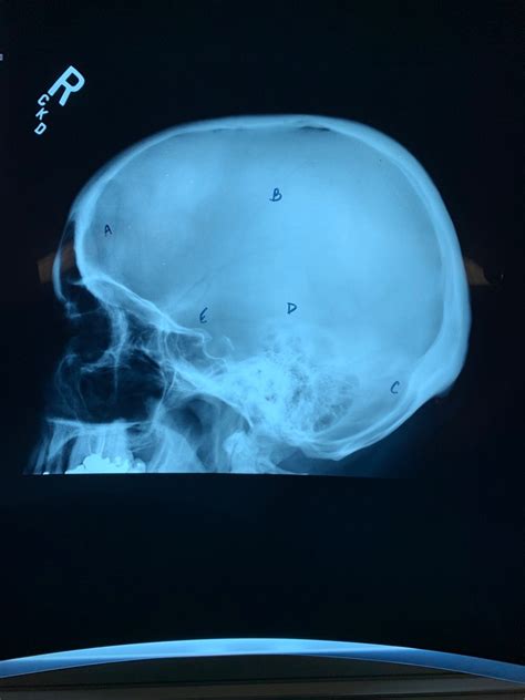 Cranial Bones Radiograph Diagram Quizlet