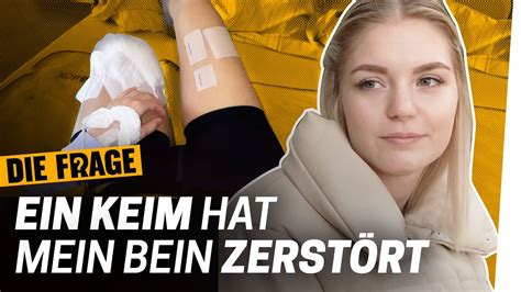 Amputation 33 Operationen Konnten Mein Bein Nicht Retten Wie Komme