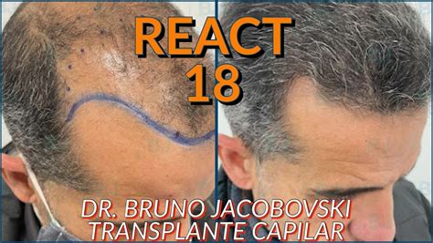 React Transplante Capilar Dr Bruno Jacobovski Youtube