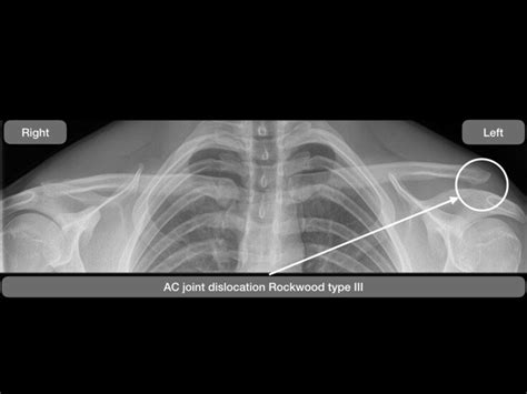 True Anteroposterior Comparative Radiograph With X Ray Beam Directed