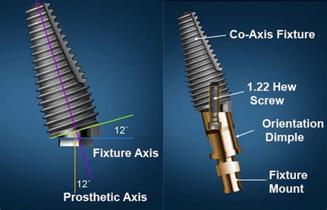 What Is The Southern Dental Implant System And Why Do We Use It At Our