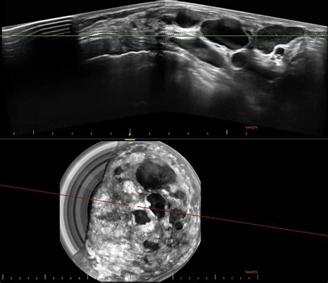 3d Automated Breast Ultrasound