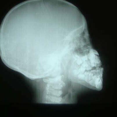 Lateral skull radiograph showing open skull sutures, large fontanelles ...