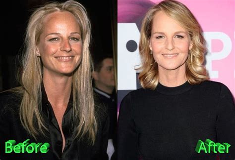 Helen Hunt Before and After Plastic Surgery - Plastic Surgery Mistakes