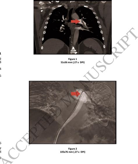 Figure From Covid Infection Complicated With Acute Pulmonary