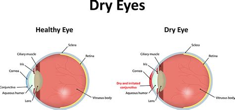 Dry Eye Syndrome Treatment