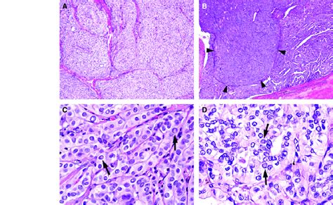 Representative Histological Findings Of Papillary Thyroid Carcinoma